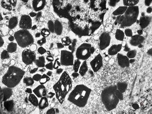 M,58y. | crystalline inclusions in hepatocyte after unknown medication M,58y. | crystalline inclusions in hepatocyte after unknown medication